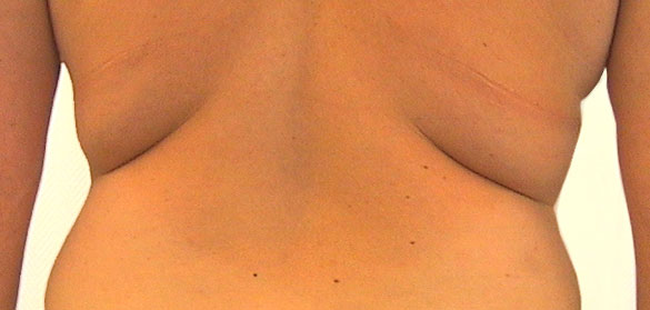 “Fett-weg”-Spritze “Fett-weg”-Spritze